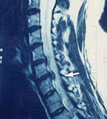 Risonanza Magnetica RM per evidenziare ernia cervicale